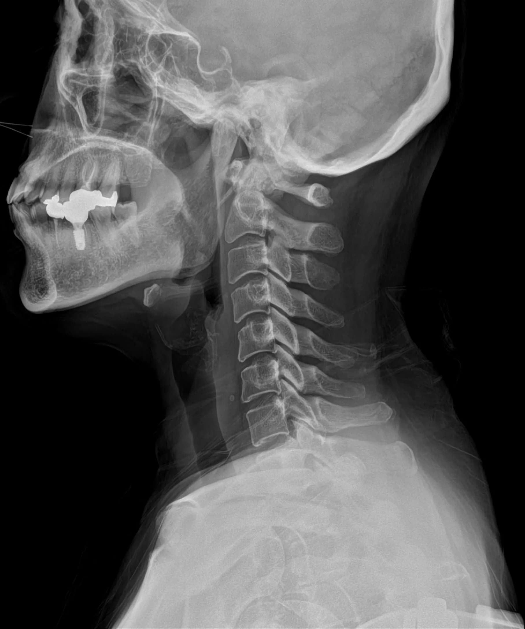 C-spine LAT original