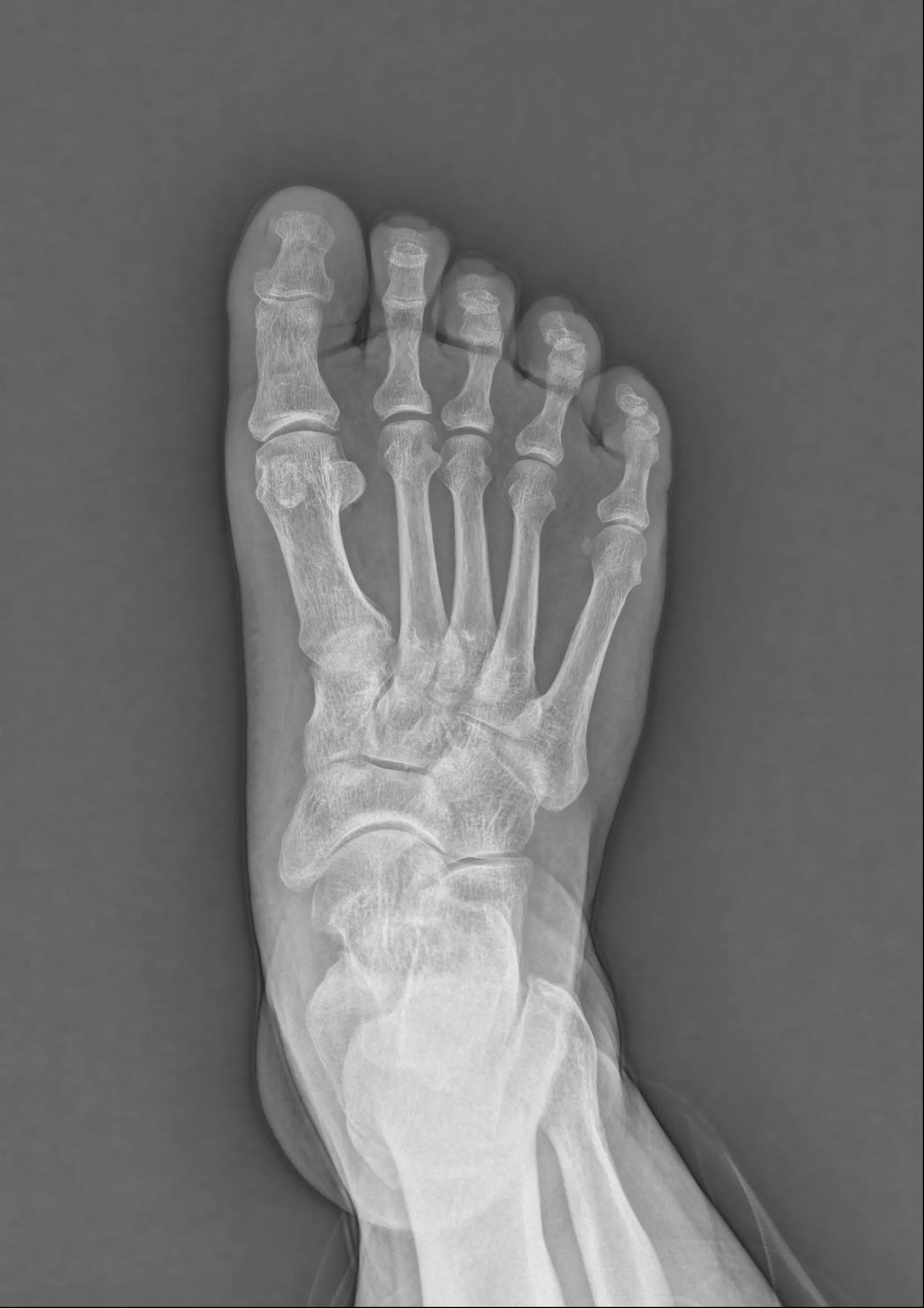 Foot AP original