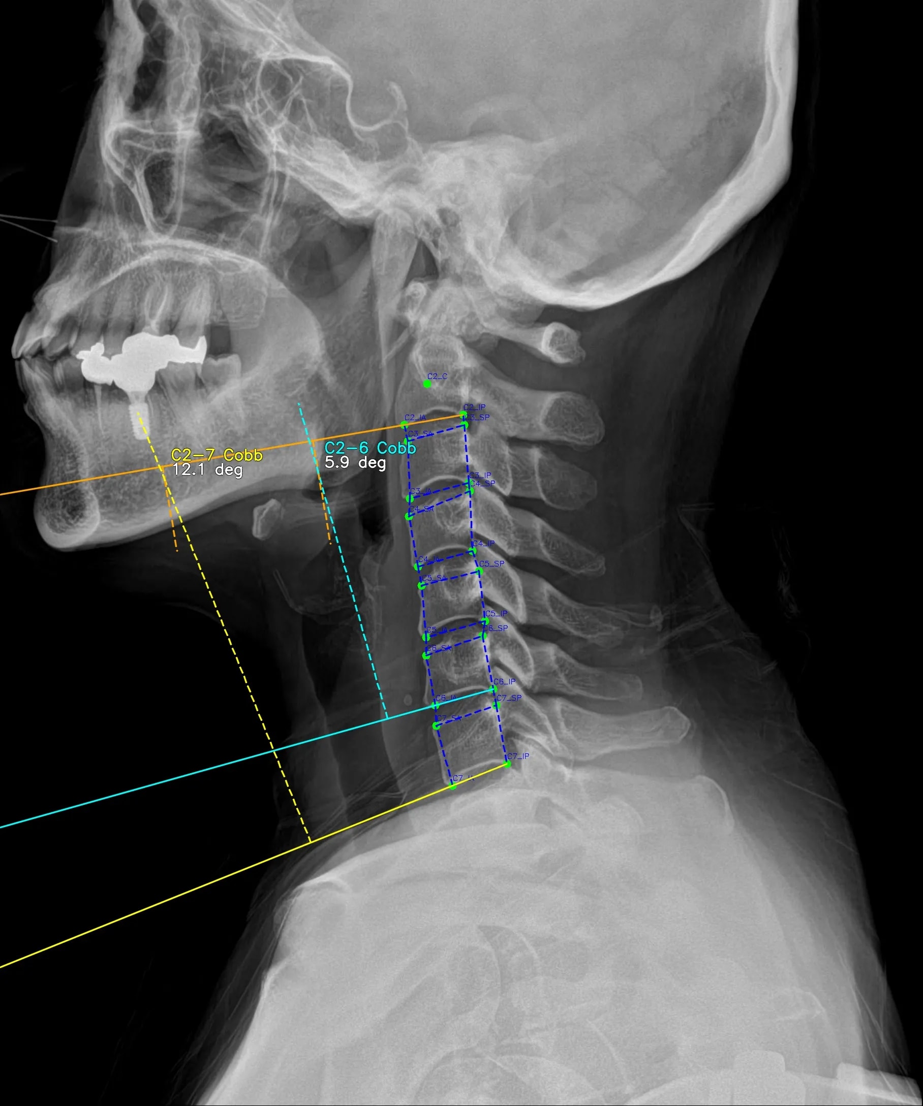 C-spine LAT result