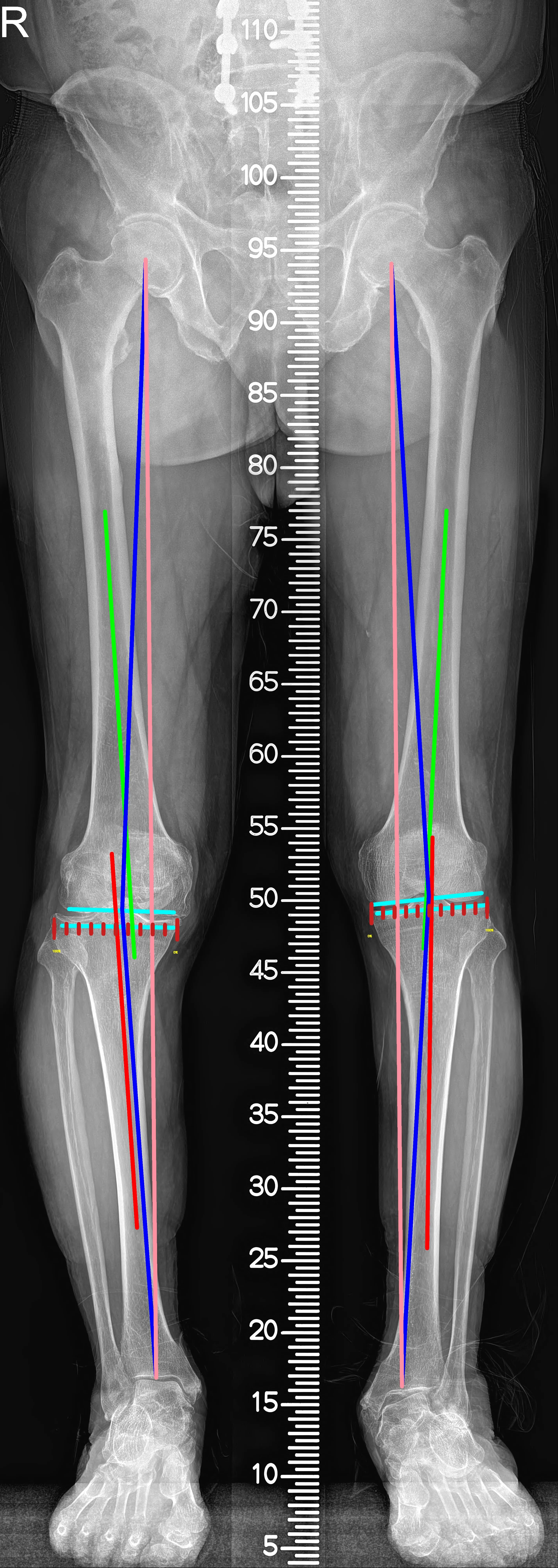 Scanogram result