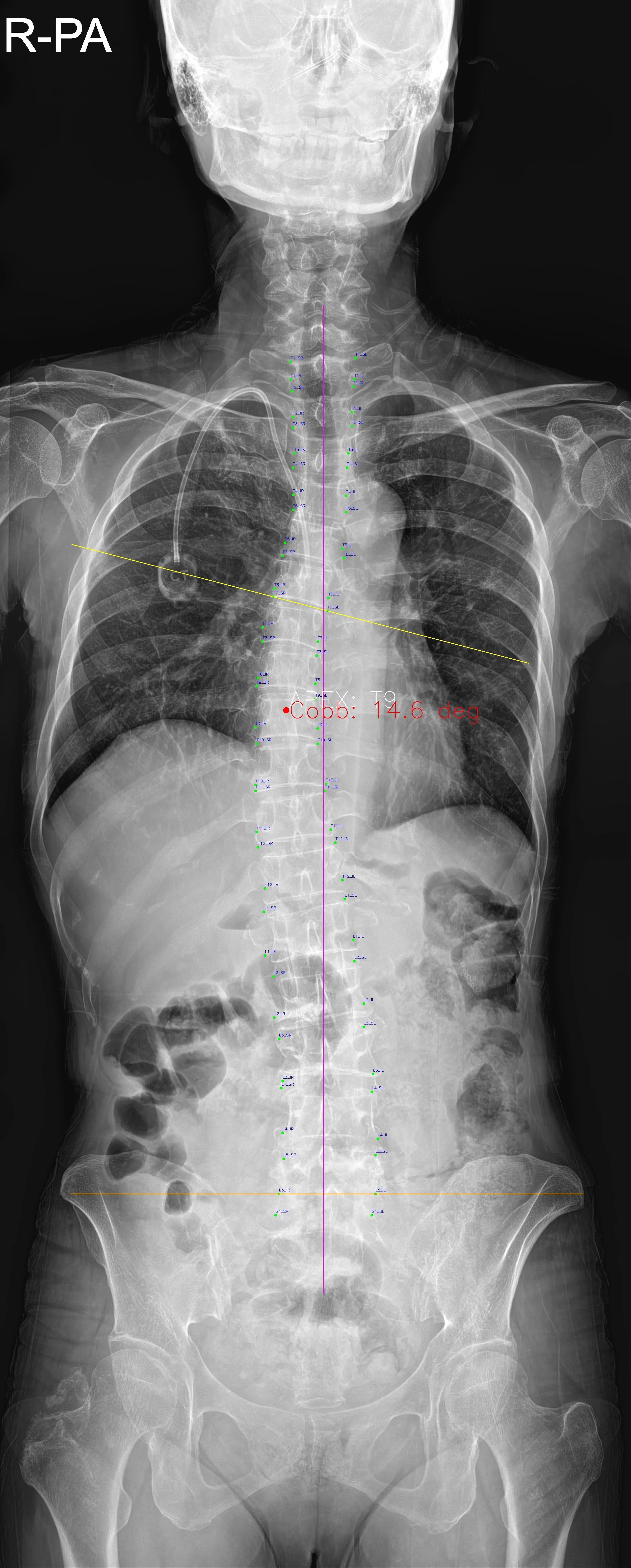 Whole Spine AP result