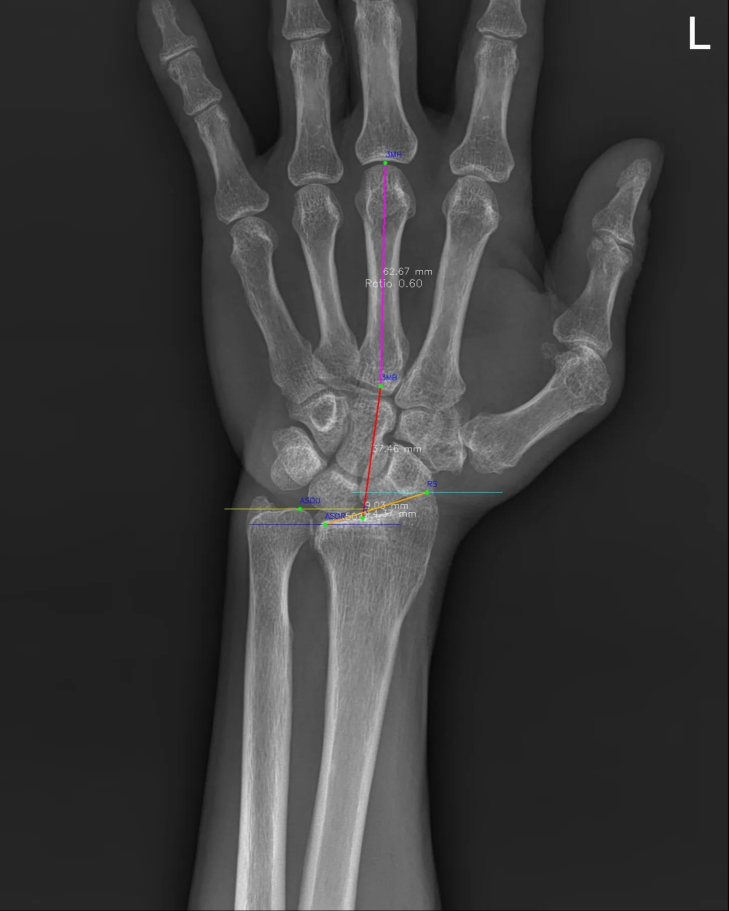 Wrist AP result