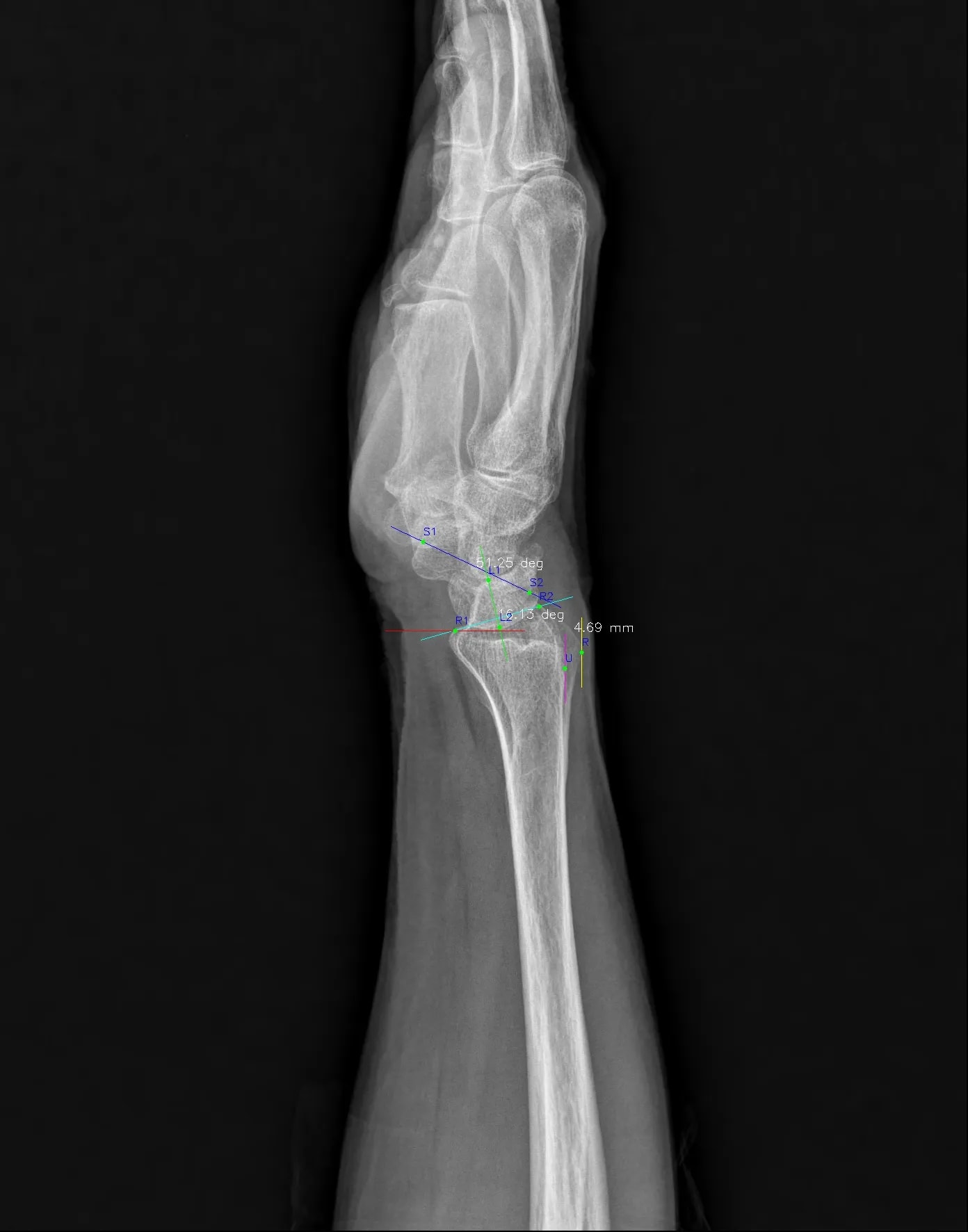 Wrist LAT result